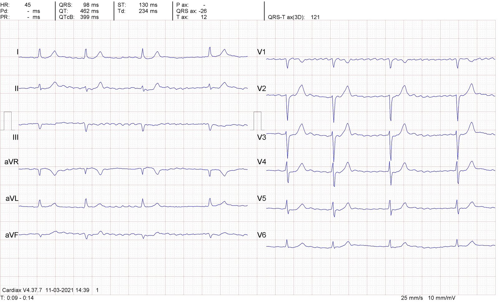 Slow atrial fibrillation