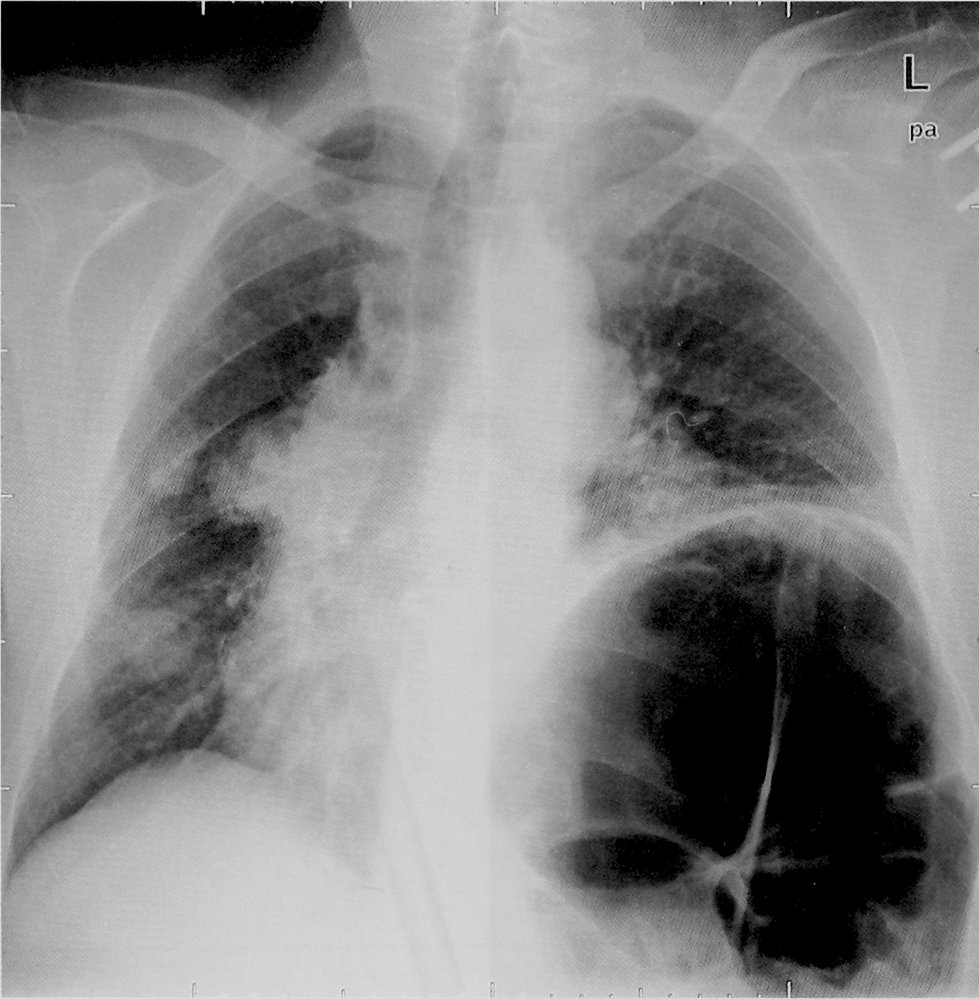 Elevation of the left hemidiaphragm from phrenic nerve paralysis 1/2
