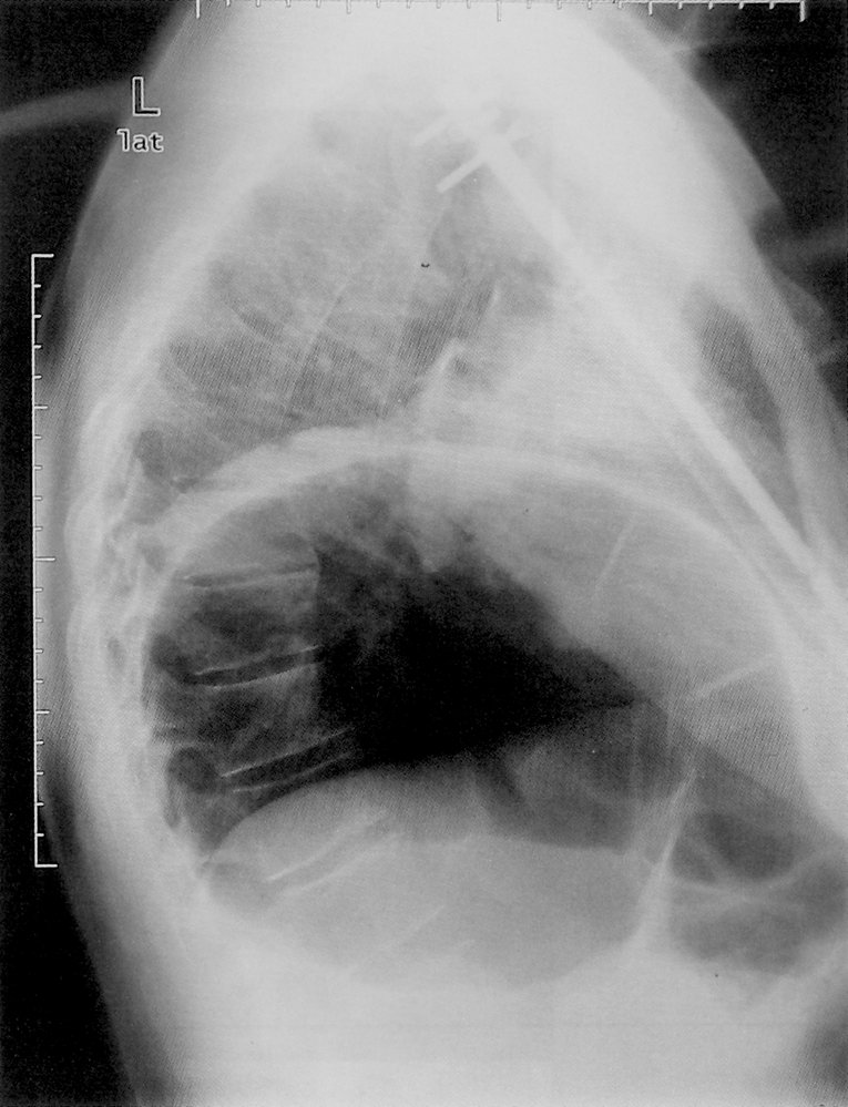 Elevation of the left hemidiaphragm from phrenic nerve paralysis 2/2