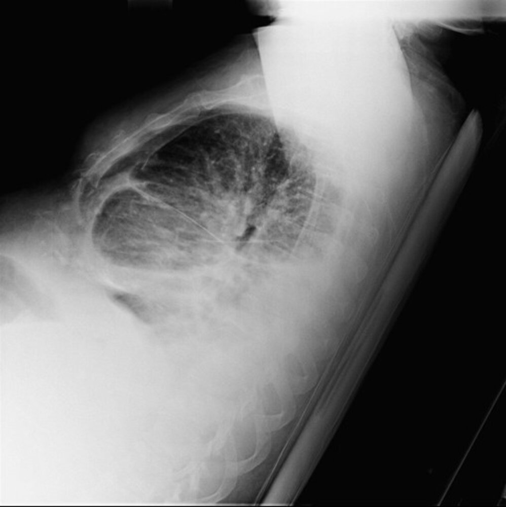 Pericardial thickening and calcification