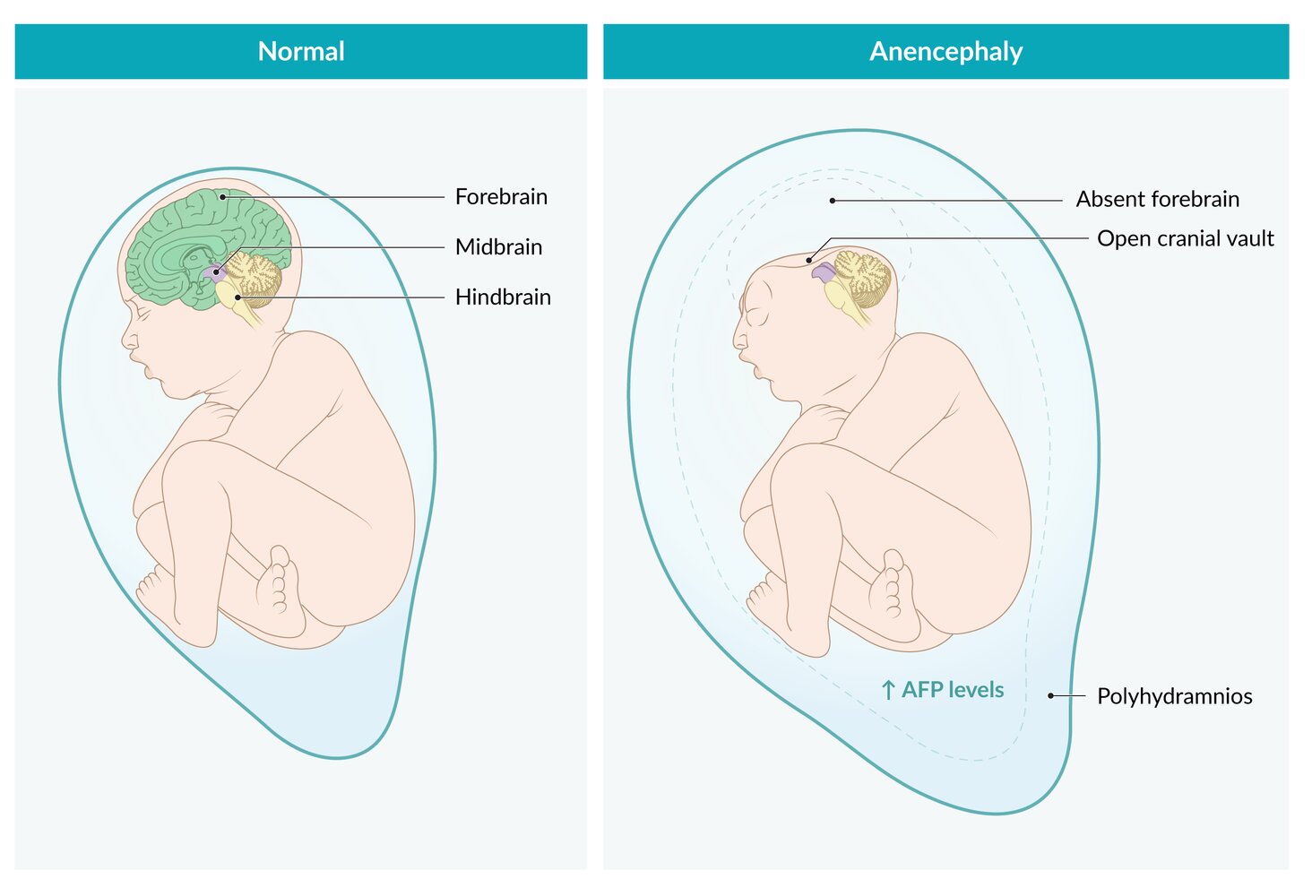 Anencephaly