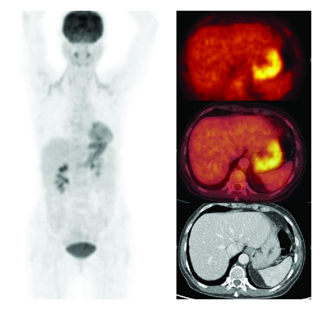FDG-PET-CT scan of inflammation