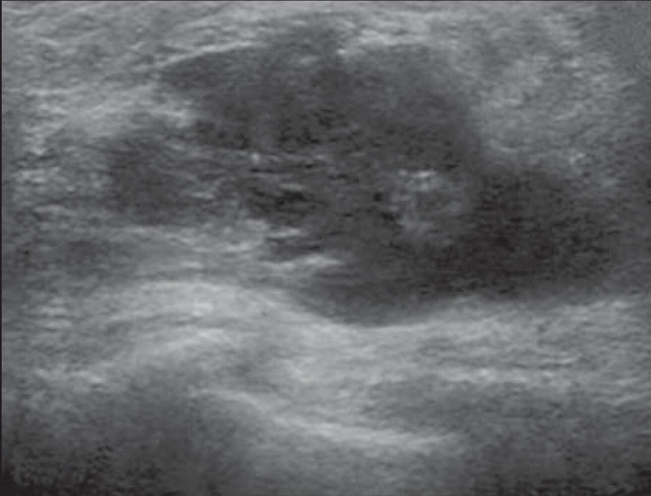 Breast abscess