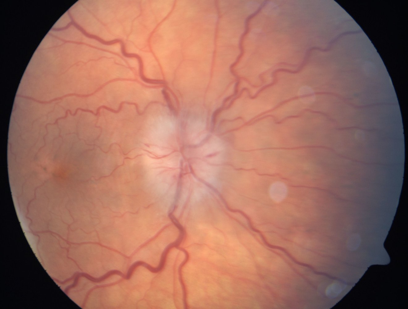 Papilledema in non-arteritic anterior ischemic optic neuropathy (NAION)