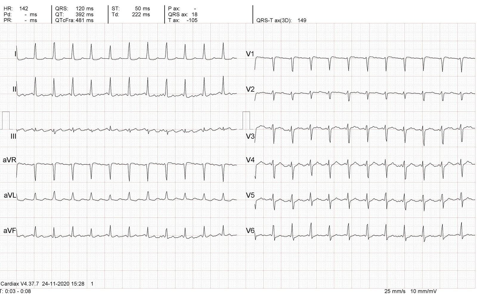 Atrial flutter with 2:1 atrioventricular (AV) block