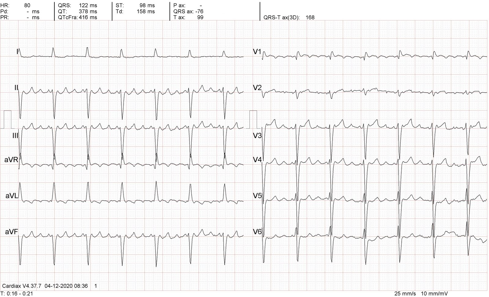 Atrial flutter with 4:1 atrioventricular (AV) block and bifascicular block