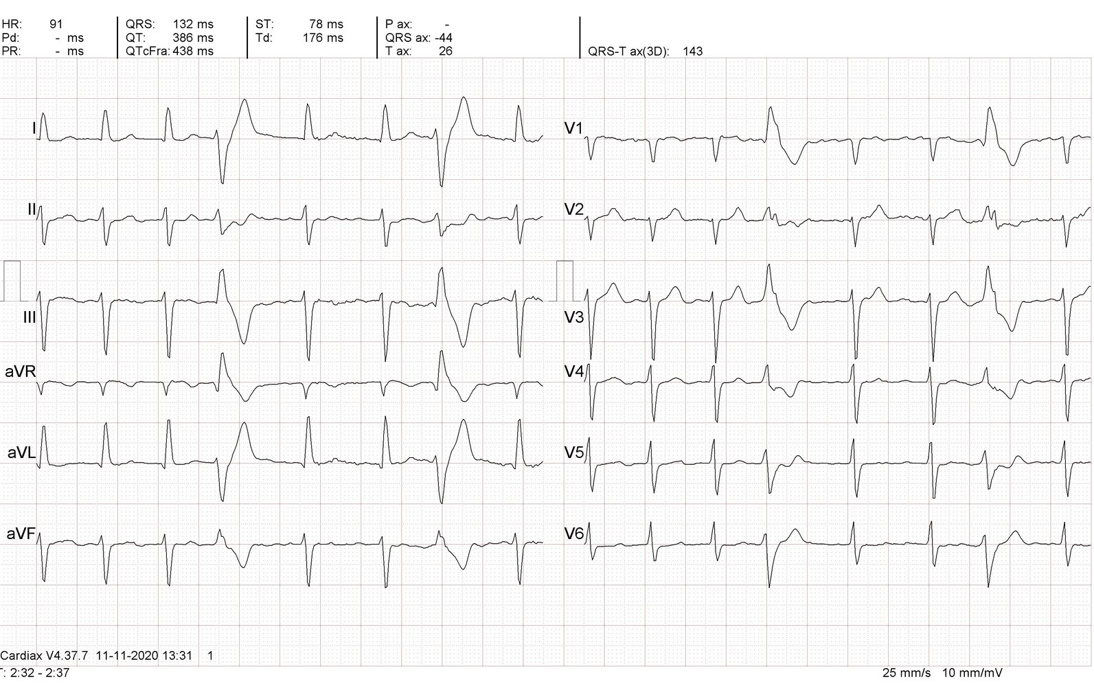 Atrial fibrillation and premature ventricular complexes