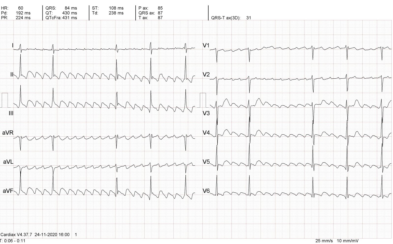 Atrial flutter with variable atrioventricular (AV) block