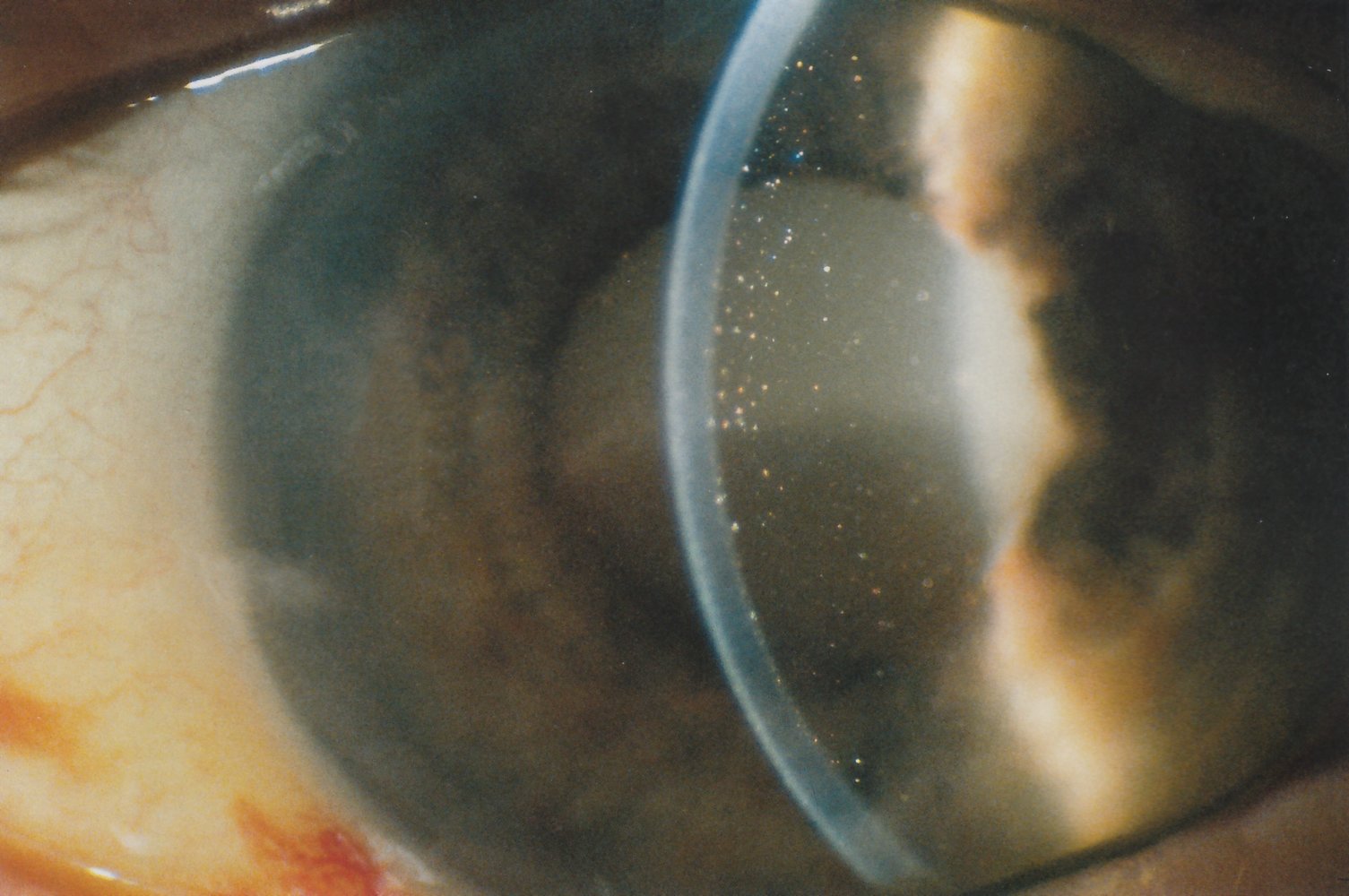 Morgagnian (hypermature) cataract