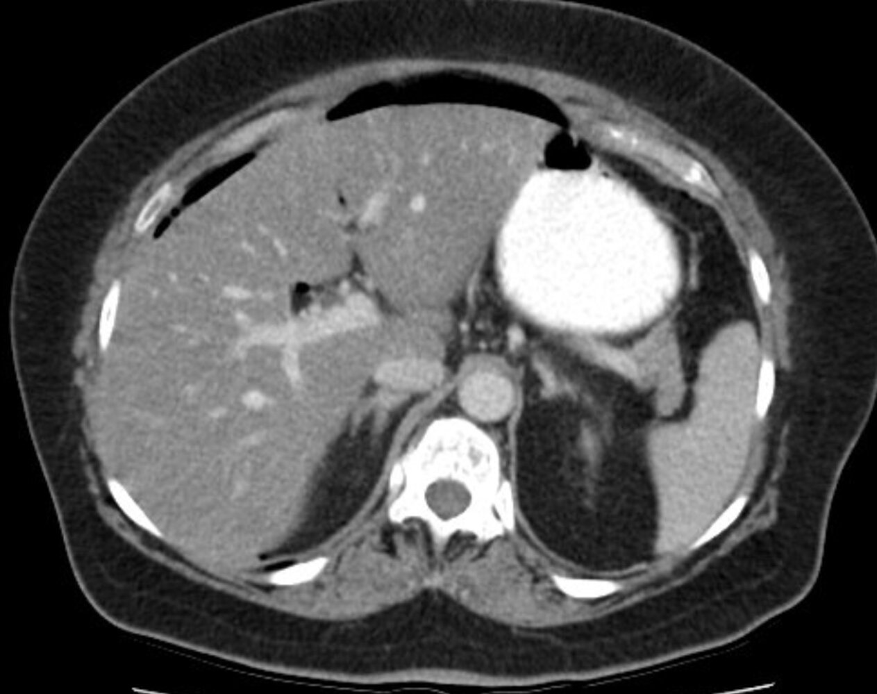 Colonic perforation