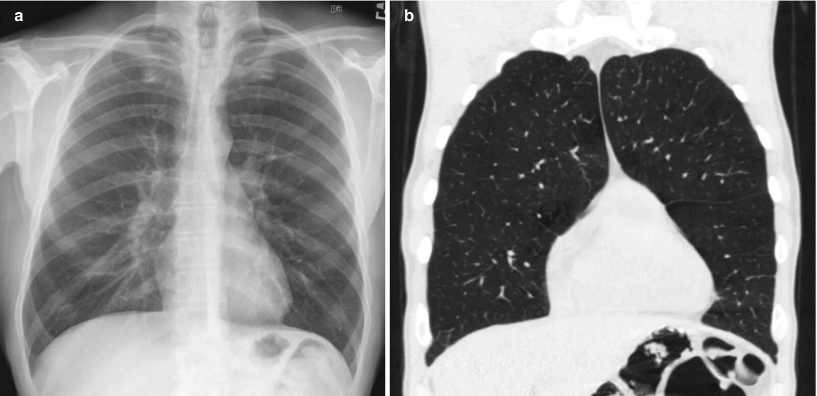Anterior junction line on frontal chest radiograph with CT correlation