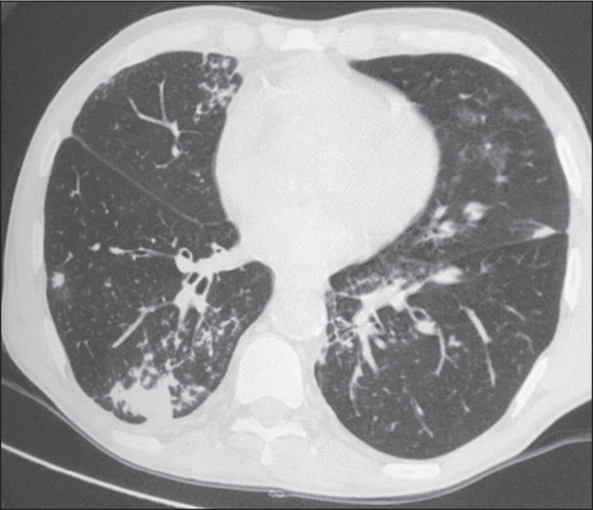Bronchopneumonia
