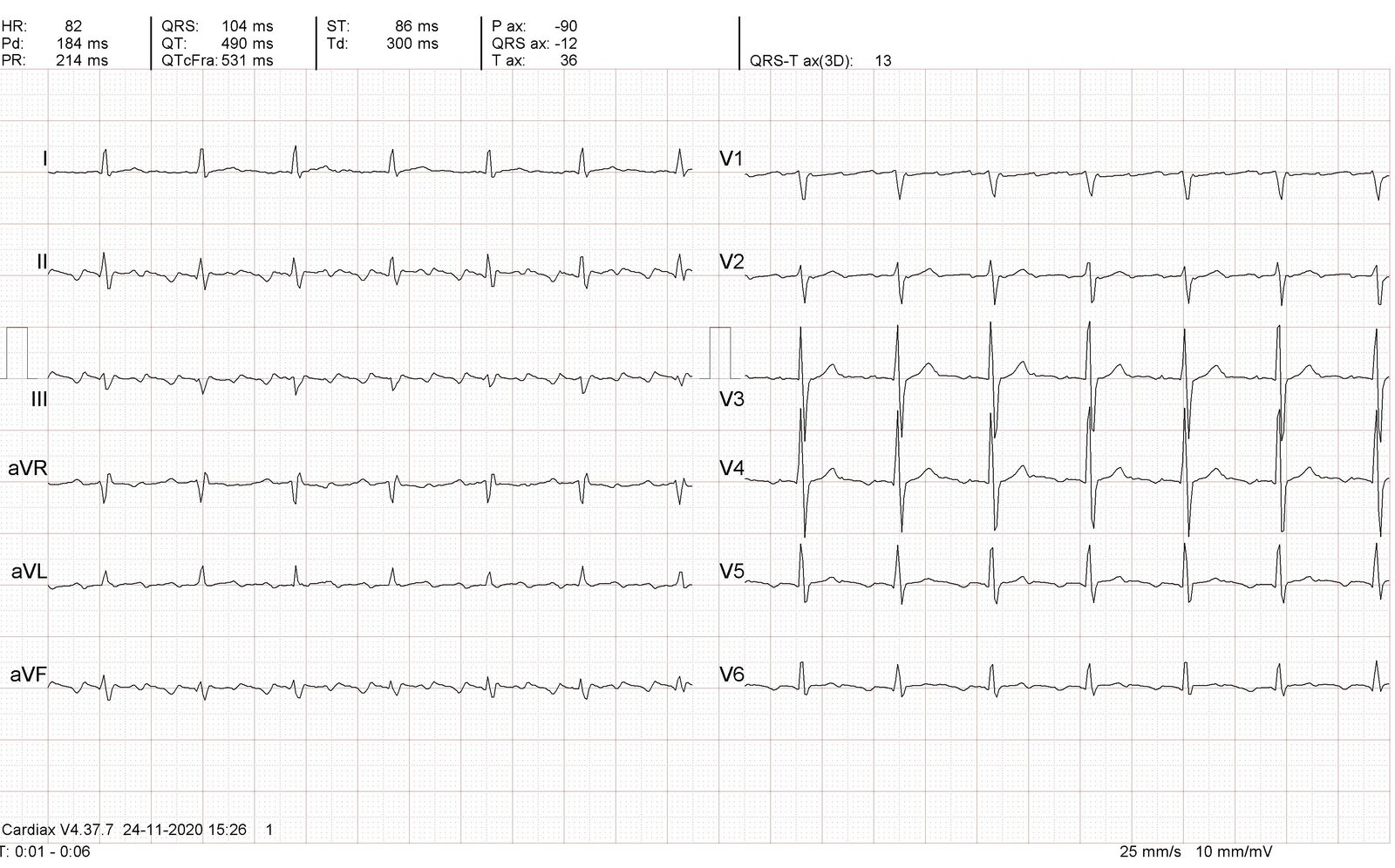 Atrial flutter with 3:1 atrioventricular (AV) block