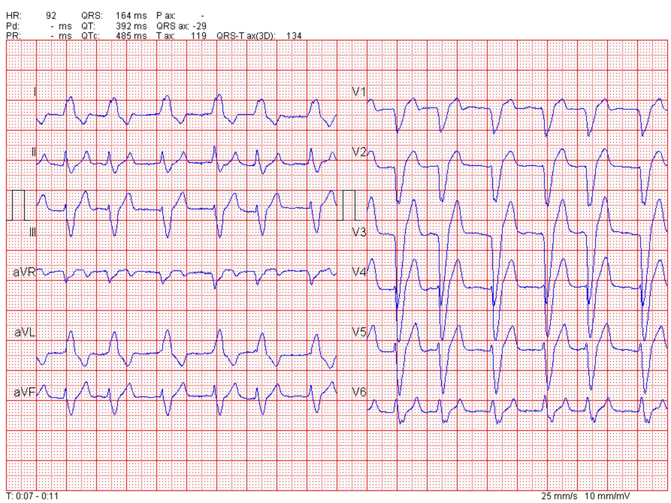 Atrial fibrillation and left bundle branch block (LBBB)