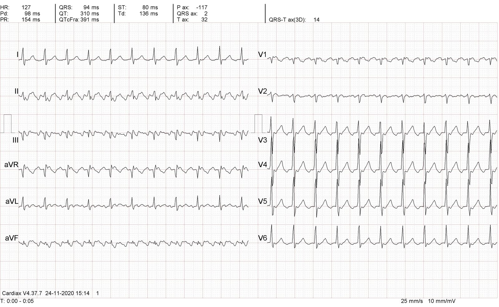 Atrial flutter with 2:1 atrioventricular (AV) block