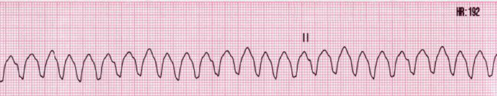 Monomorphic ventricular tachycardia
