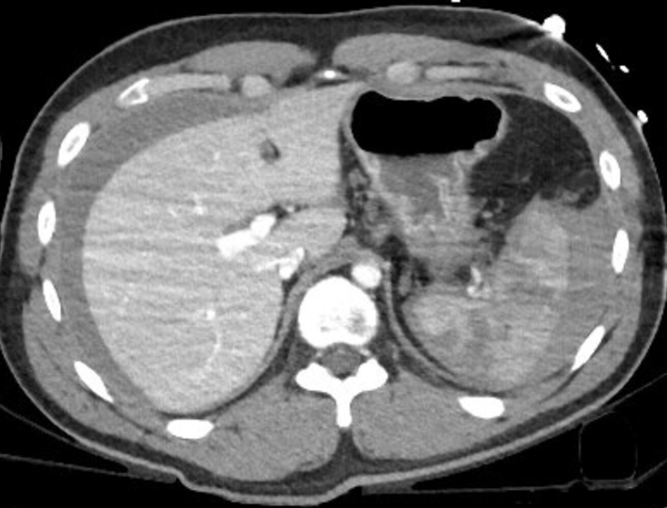 Lacerated spleen