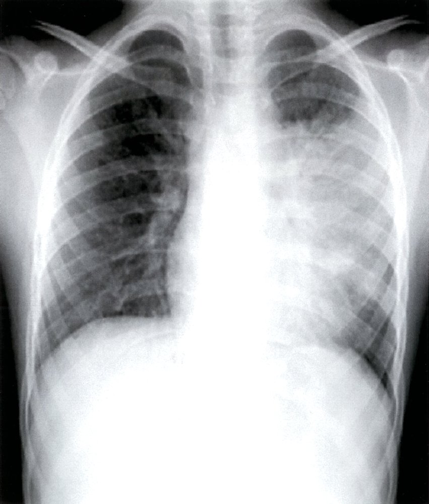 Left upper lobe pneumonia 1/2