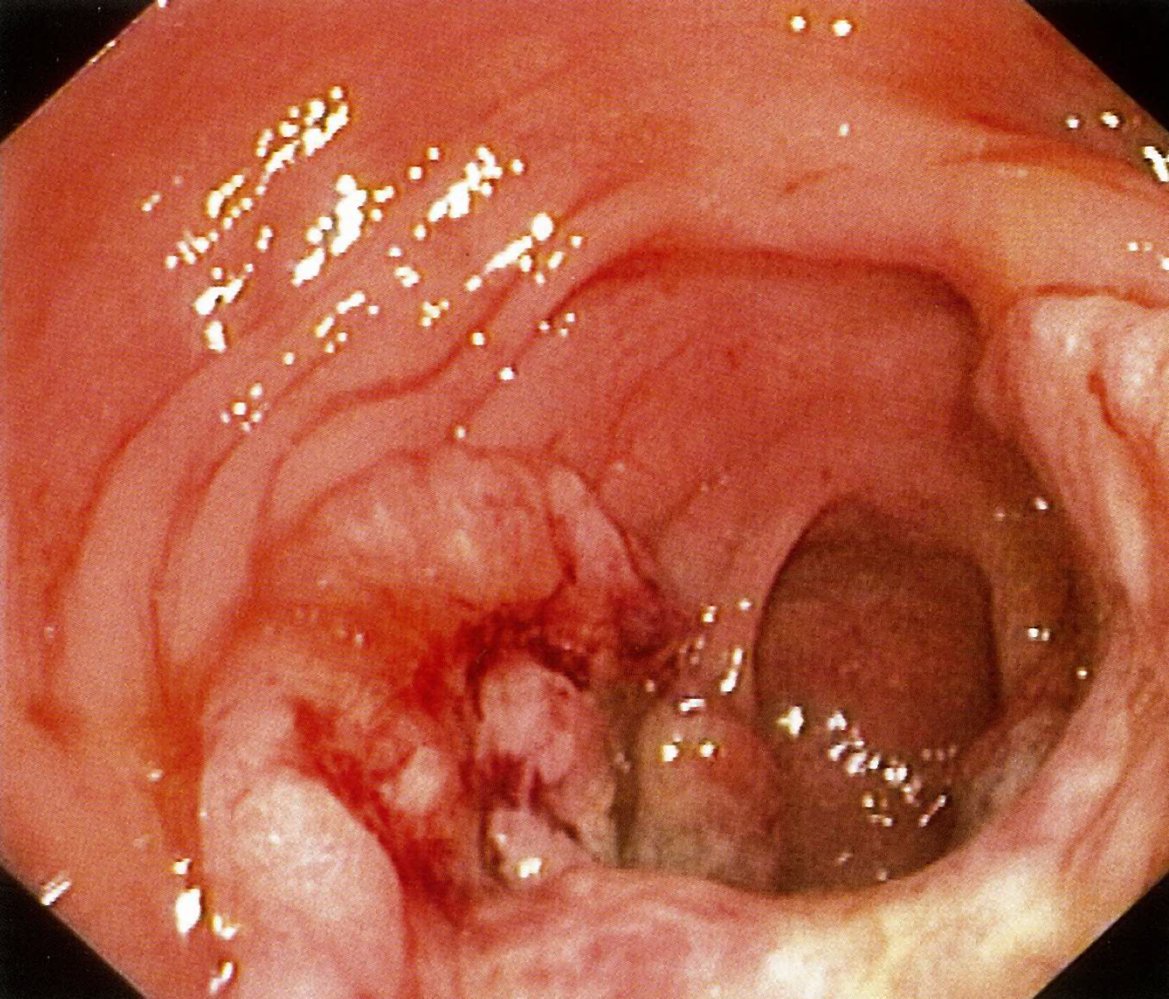 Colon cancer