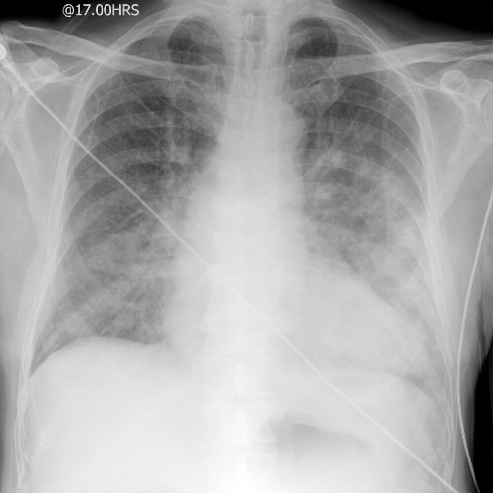 Bilateral air space and interstitial disease in acute pulmonary edema