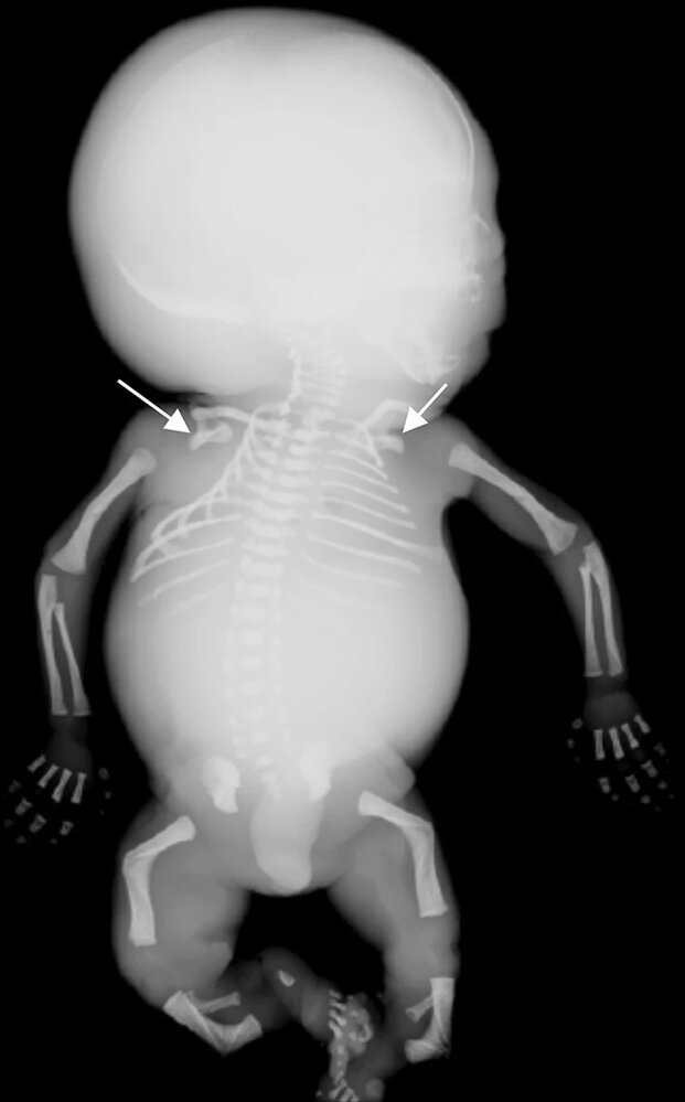 Campomelic dysplasia
