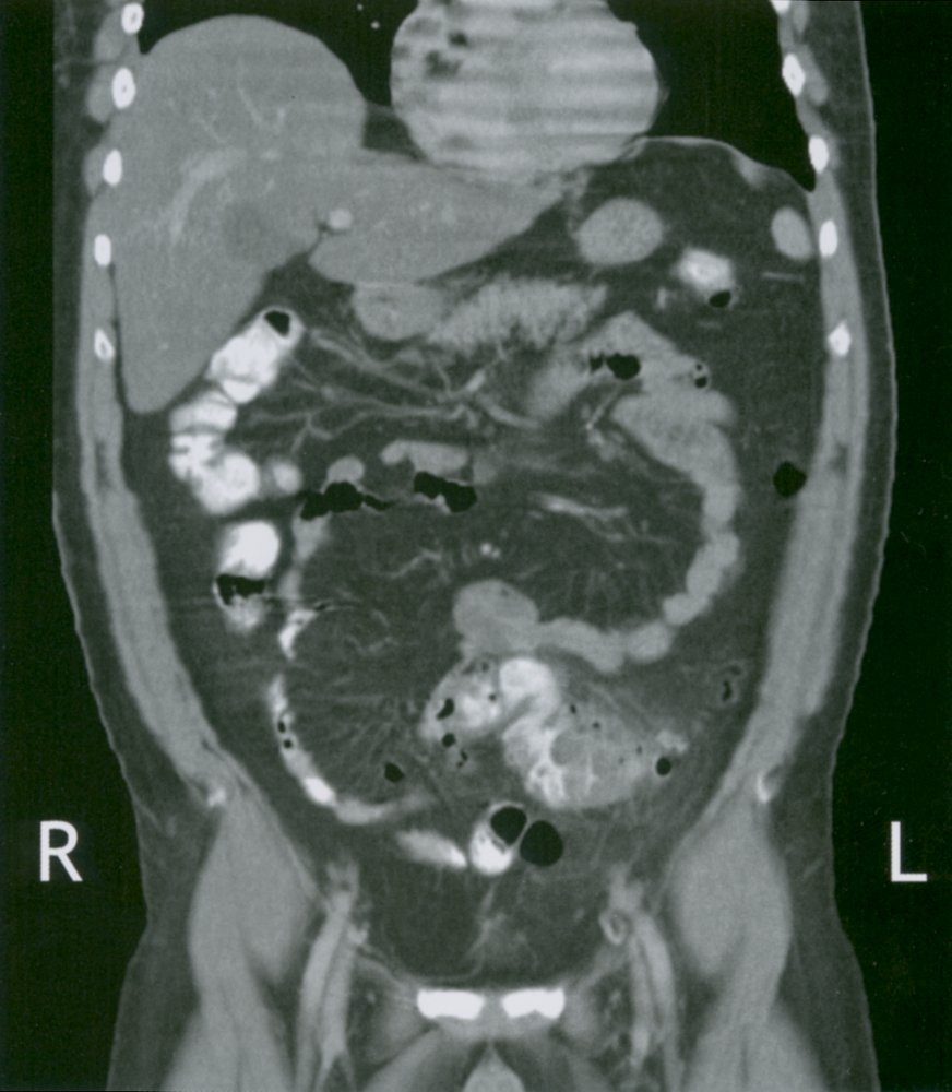 Diverticulitis