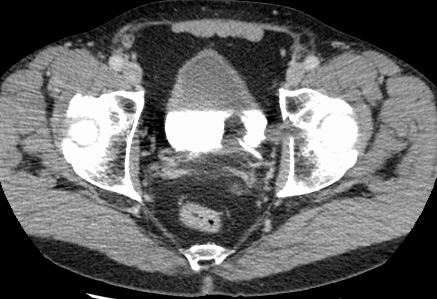 Bladder mass