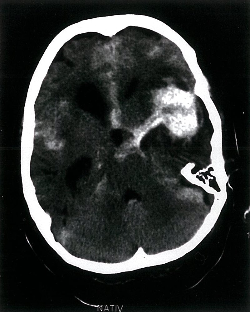 Ruptured middle cerebral artery aneurysm