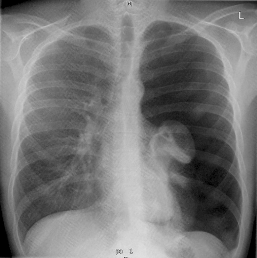 Tension pneumothorax
