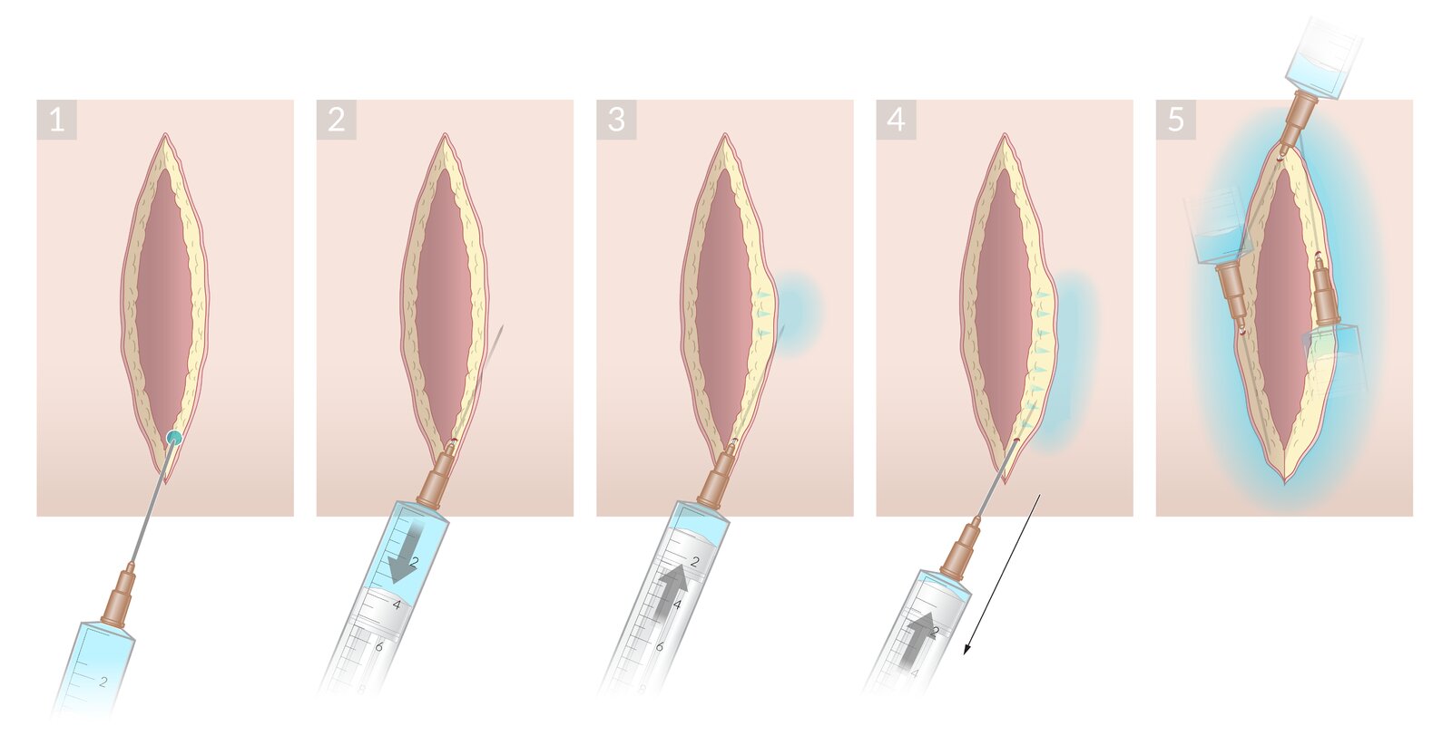 Local anesthesia for wound repair