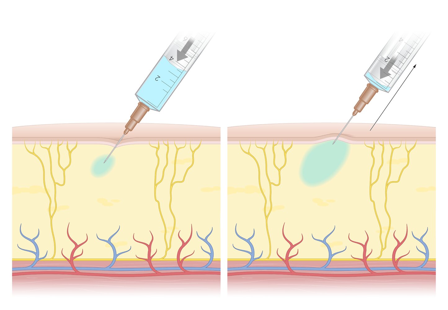 Single point local anesthesia