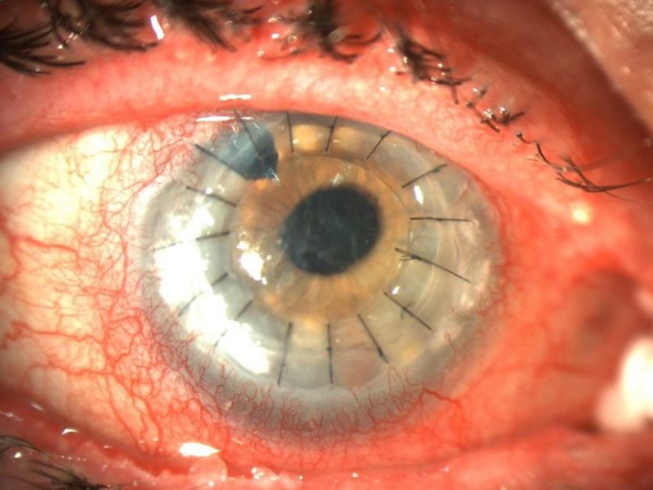 Fresh keratoplasty