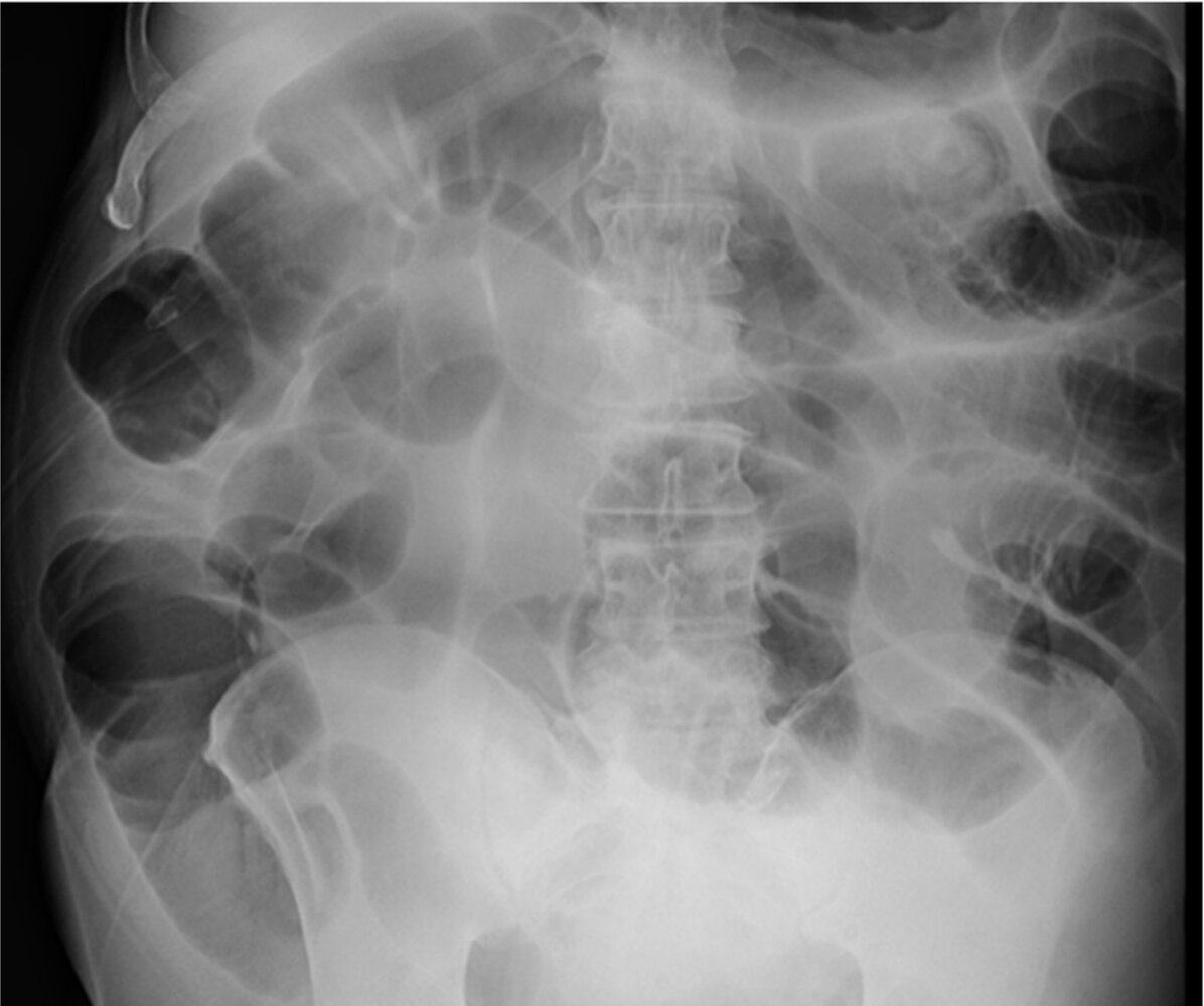 Paralytic ileus