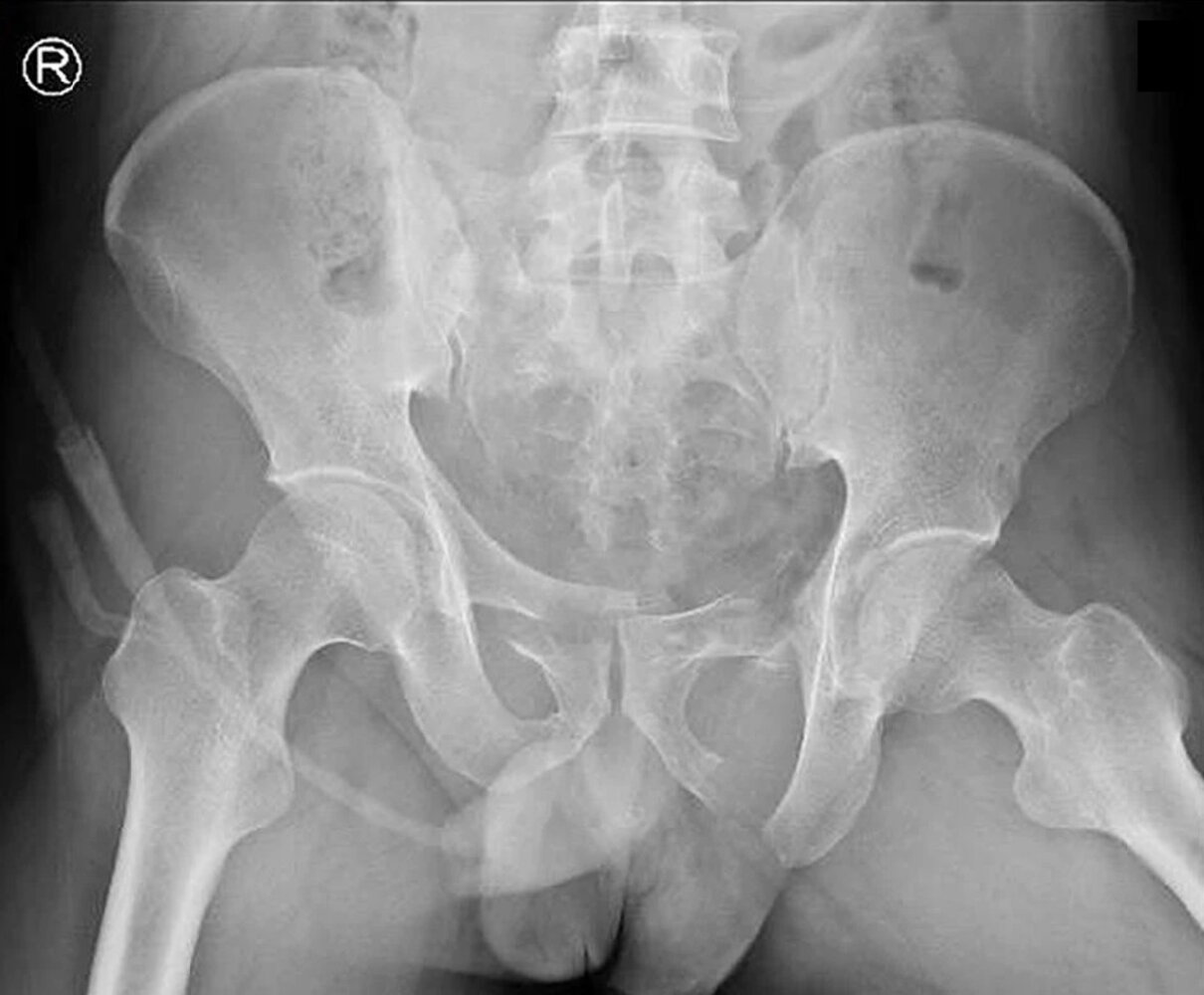 Unstable pelvic ring fracture
