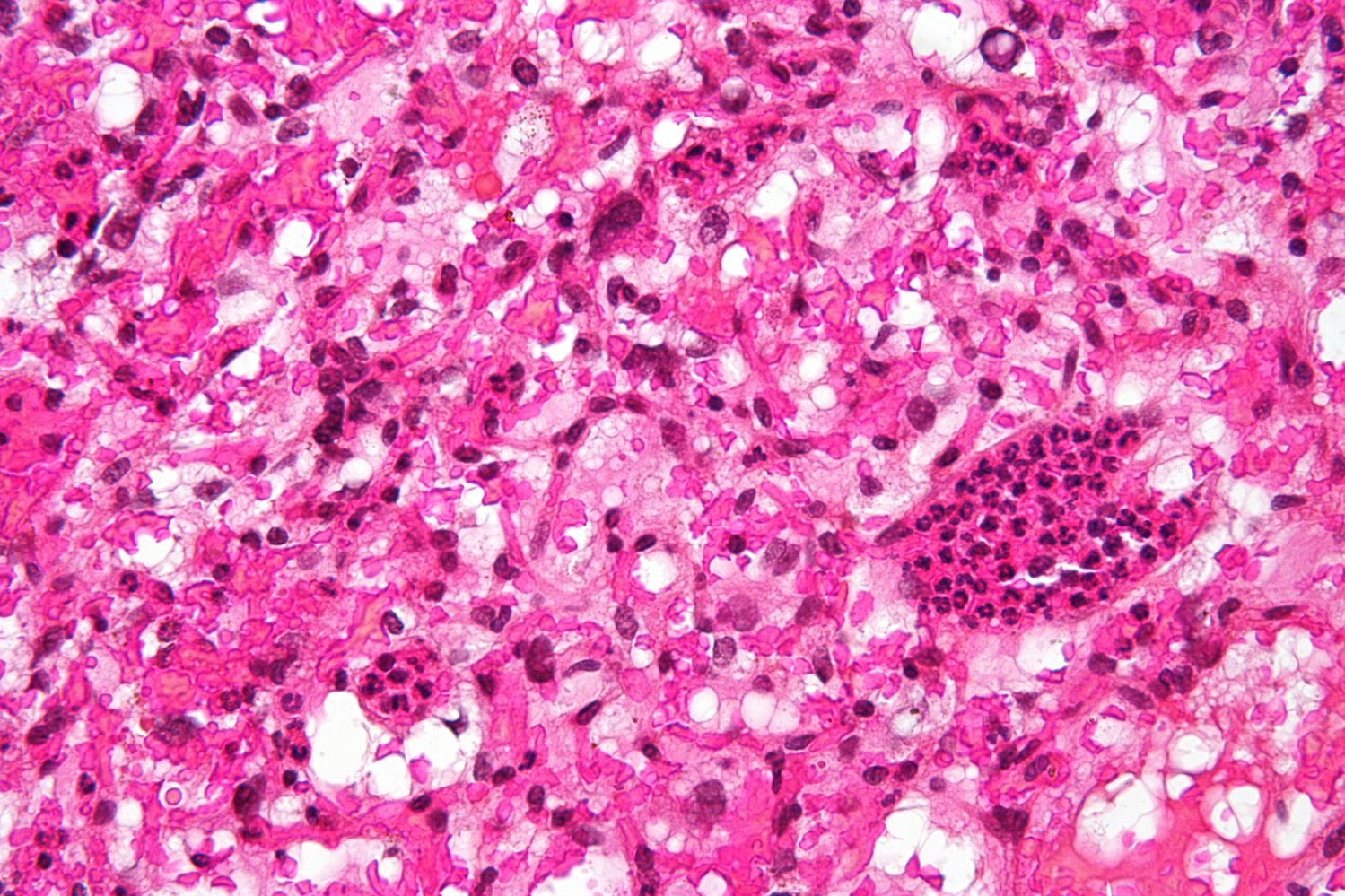 Cerebellar hemangioblastoma (WHO grade I)