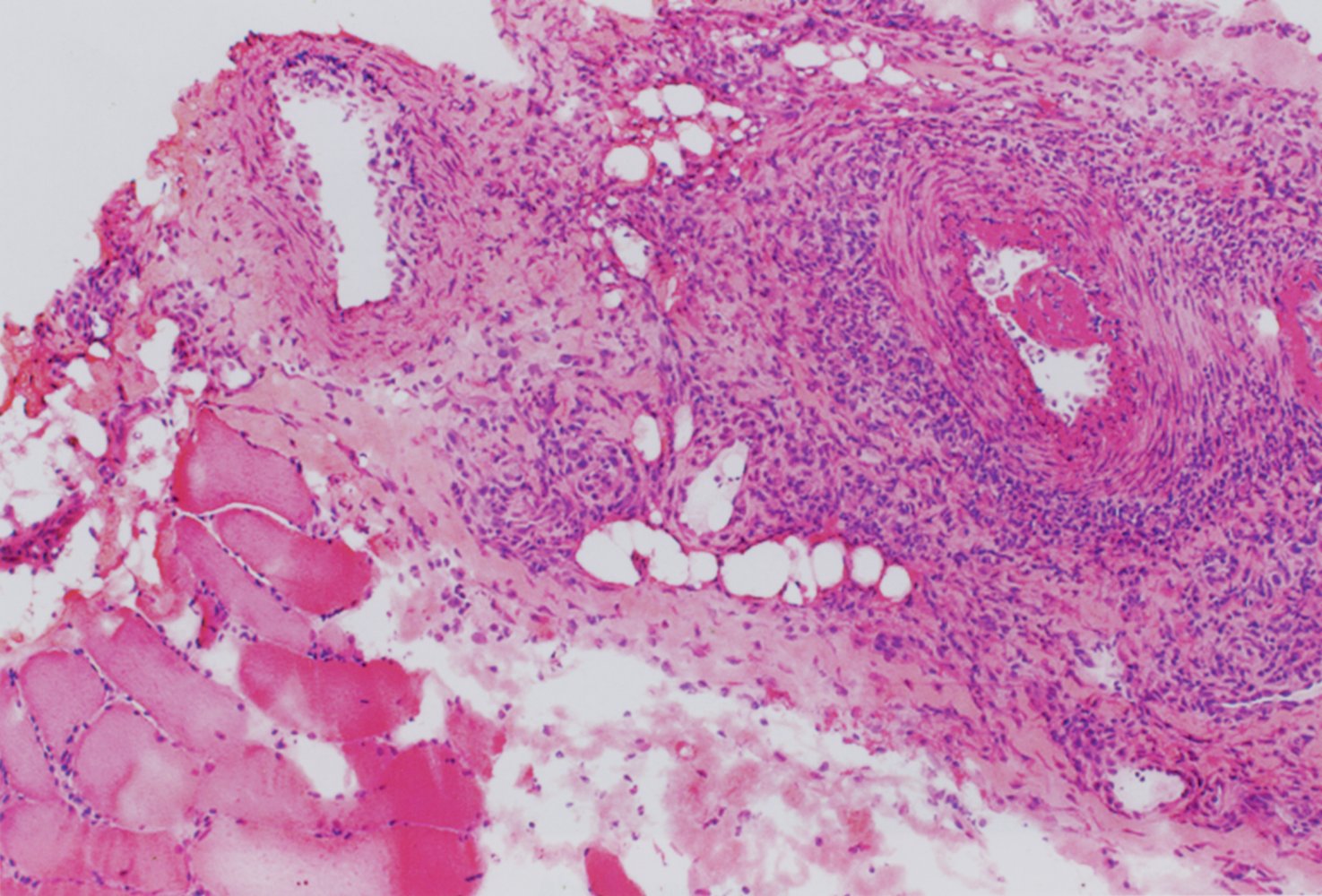 Muscle involvement in polyarteritis nodosa