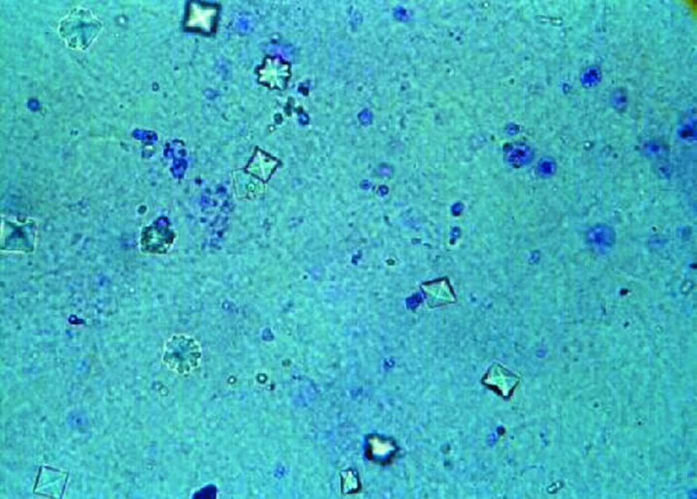 Calcium oxalate crystals in urine