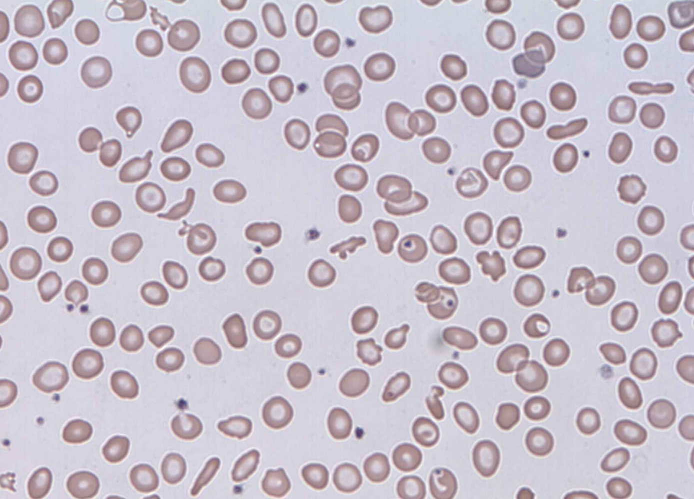 Schistocytes