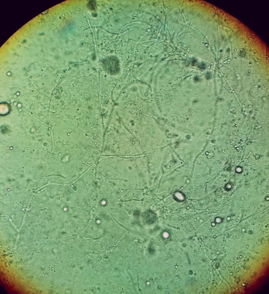 Pseudohyphae in vulvovaginal candidiasis
