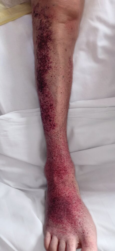 Petechiae in immune thrombocytopenia
