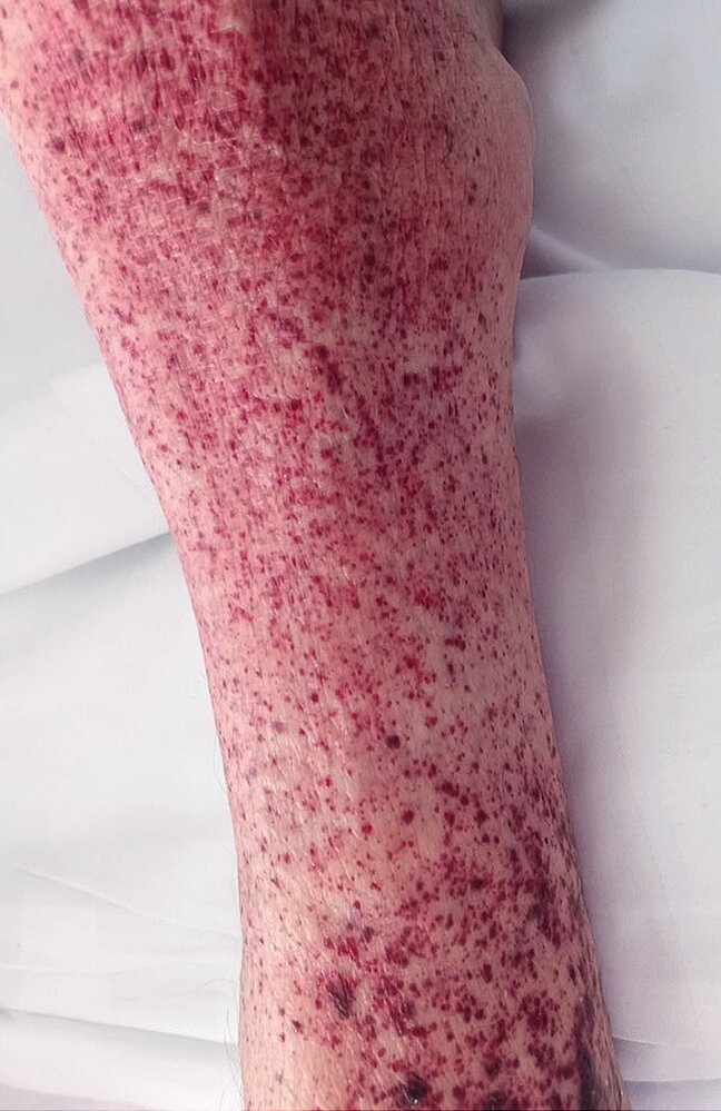 Petechiae in immune thrombocytopenia