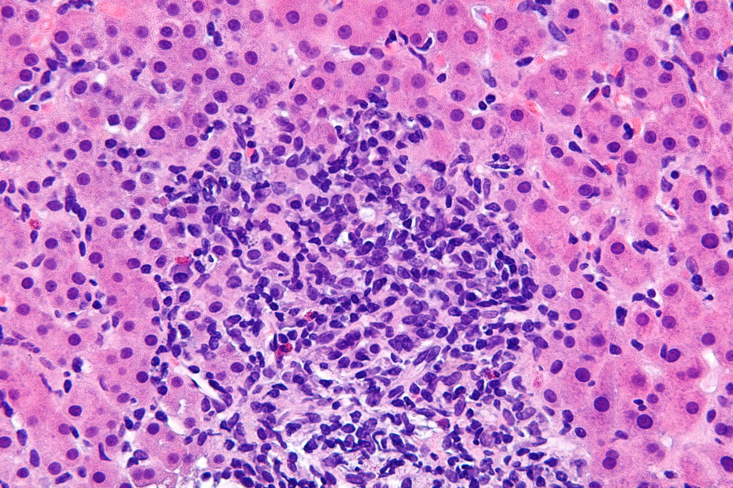 Chronic hepatitis