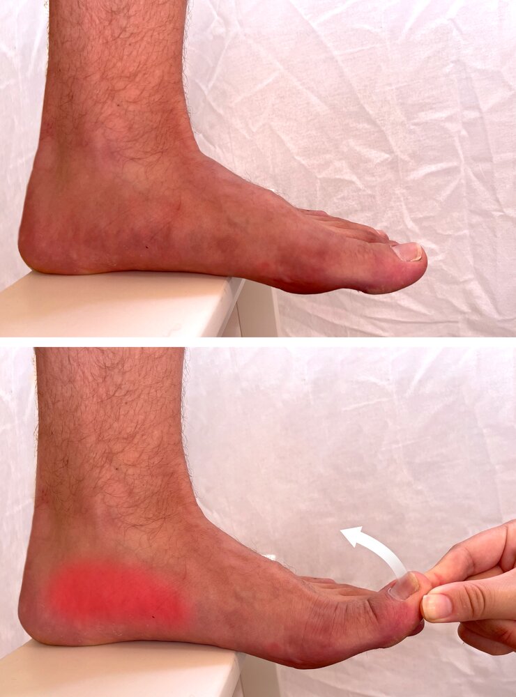 Windlass test for plantar fasciitis