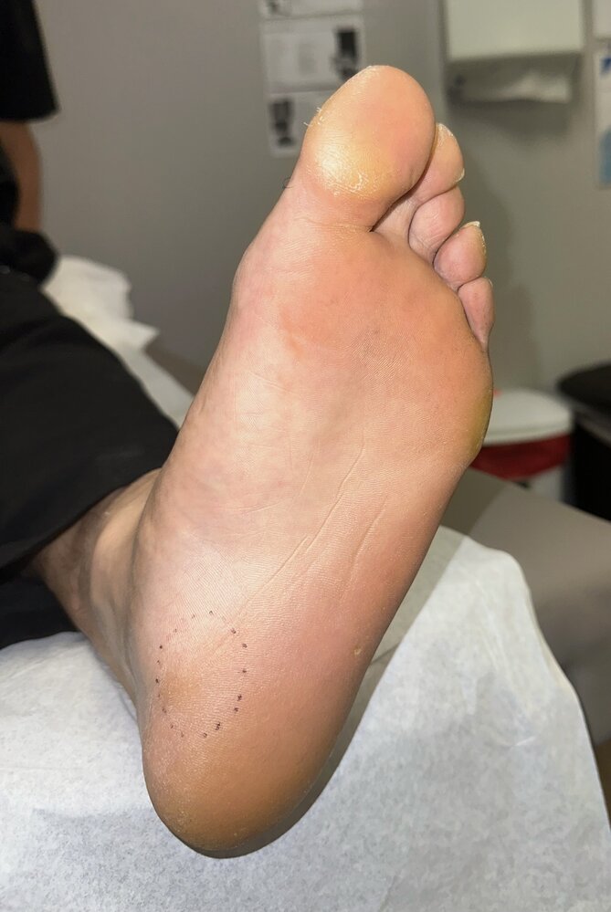 Area of tenderness on palpation in plantar fasciitis