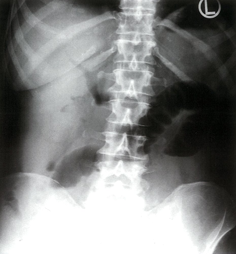 Colonic obstruction and pneumobilia
