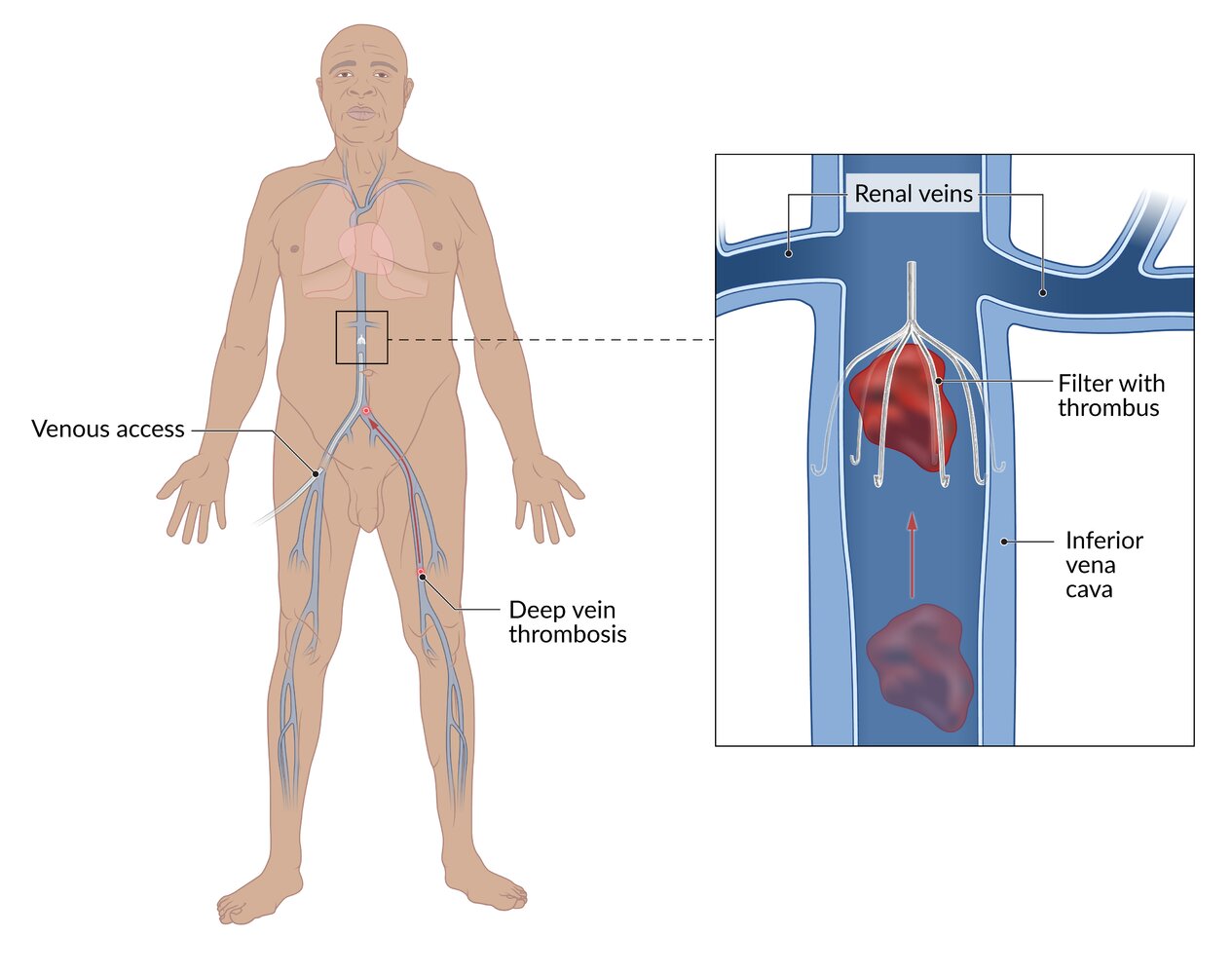 Inferior vena cava filter