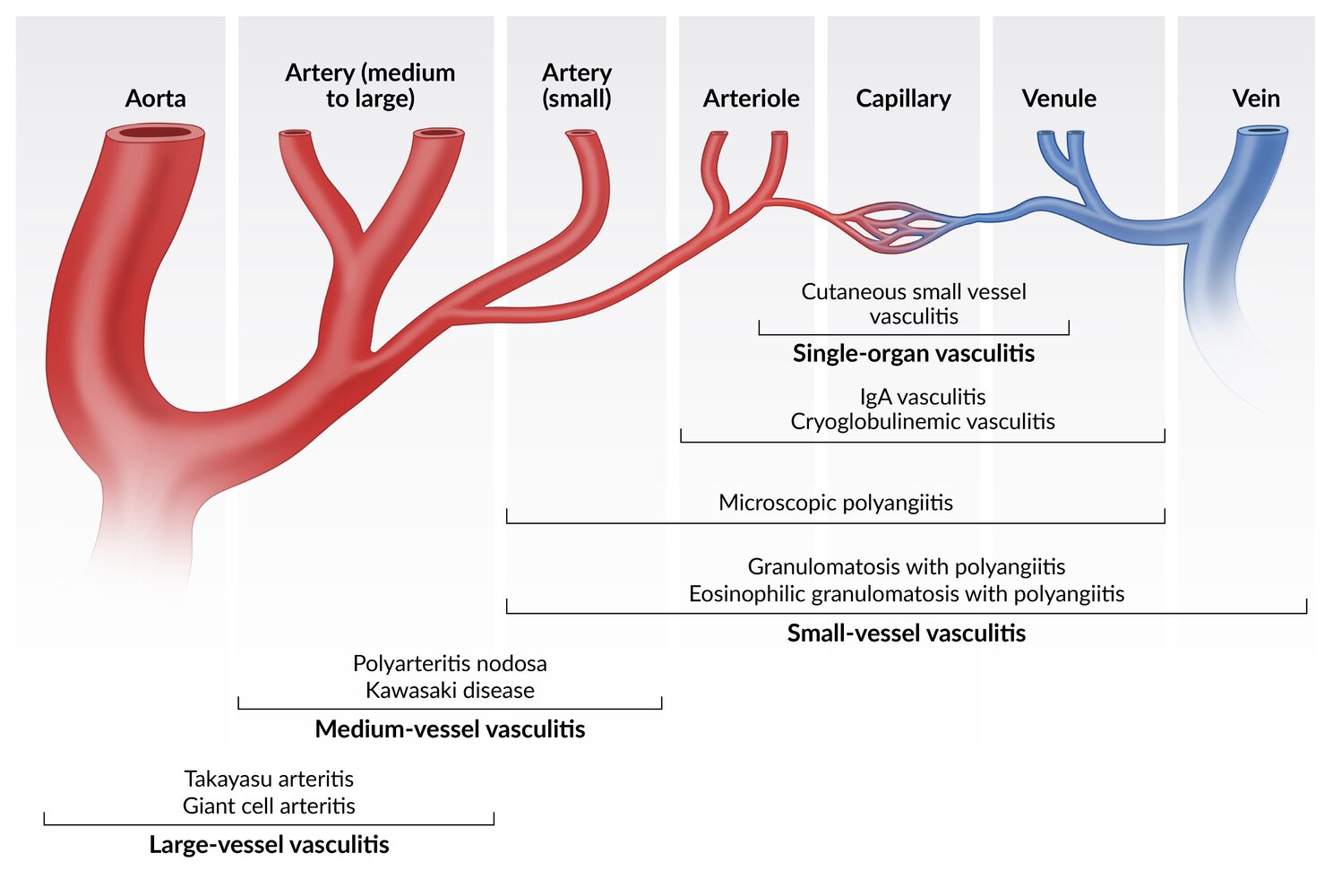 Types of vasculitis