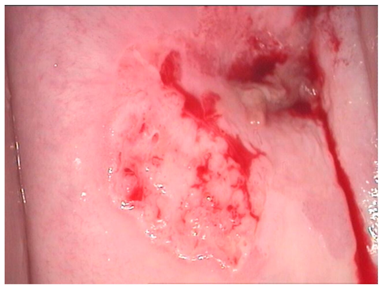 High-grade squamous intraepithelial lesion (HSIL) of the cervix