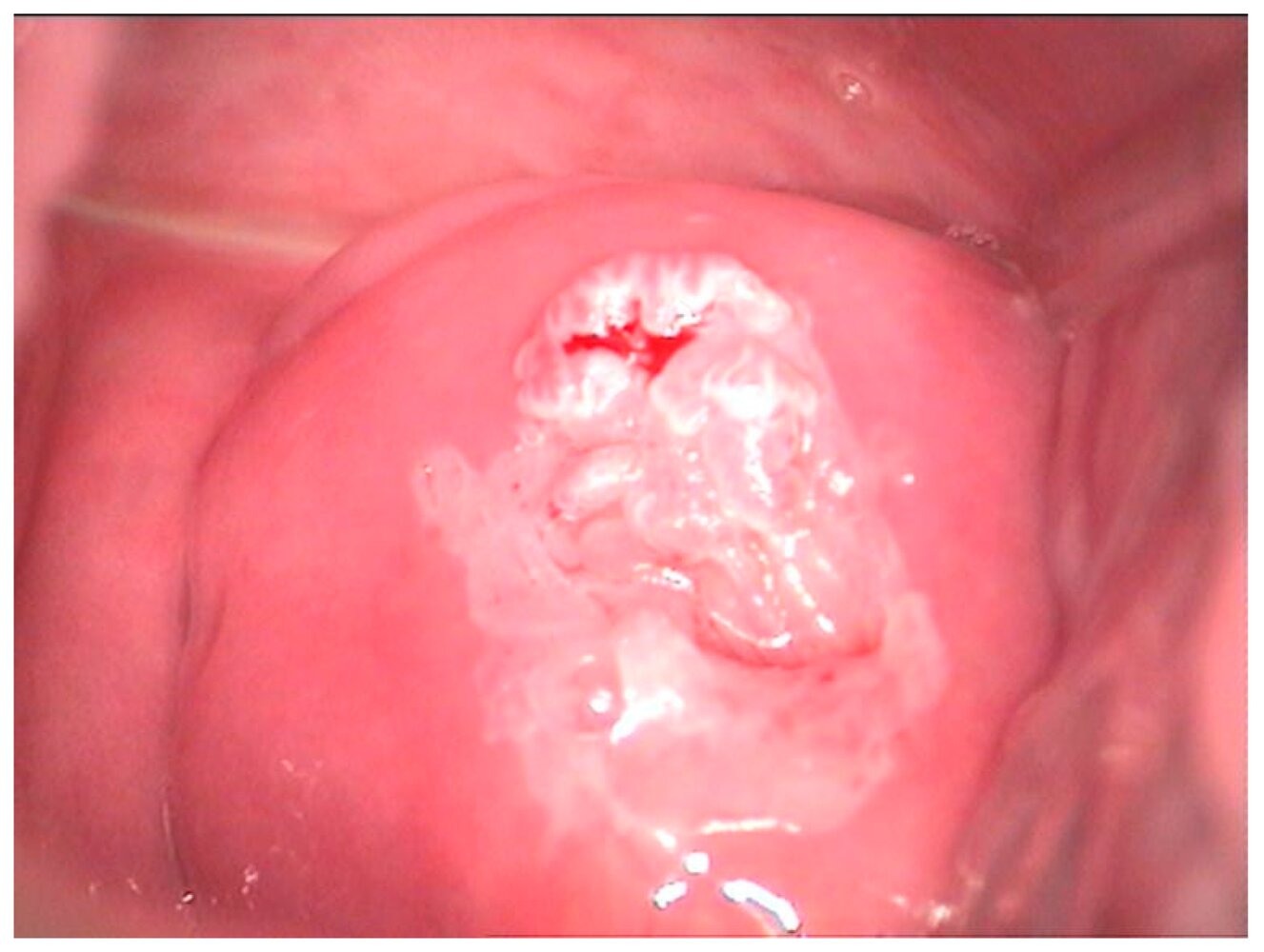 Cervical intraepithelial neoplasia (CIN 2)