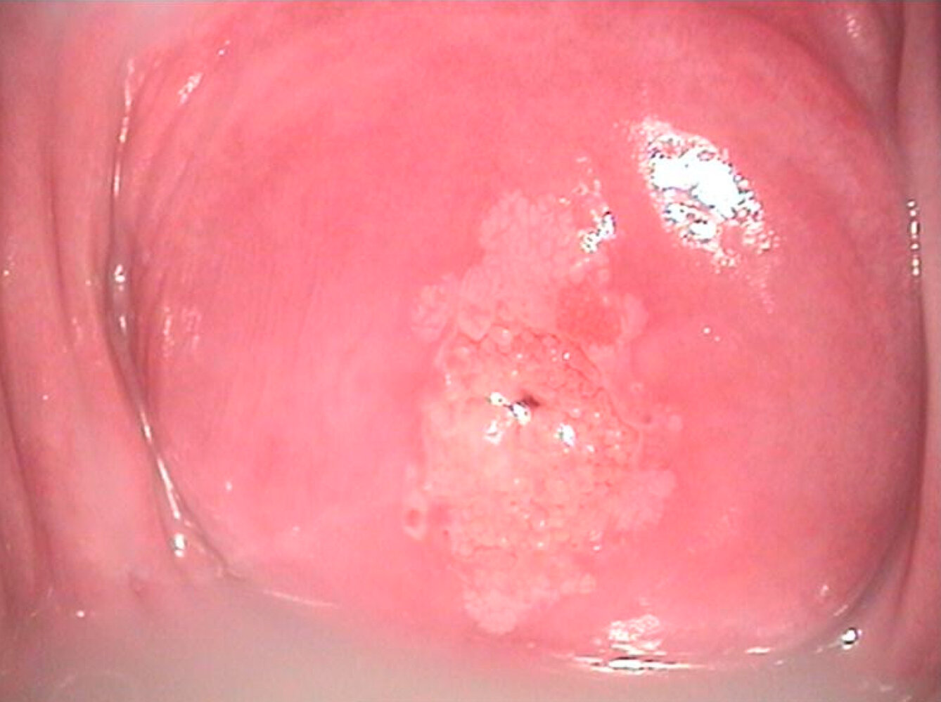 Low-grade squamous intraepithelial lesion (LSIL) of the cervix